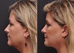 Facial Liposuction Photos - Cincinnati Facial Plastic Surgery