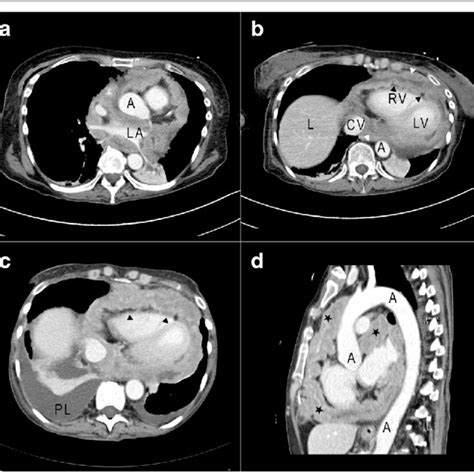 Contrast Enhanced Computed Tomography Of The Thorax Before A B And