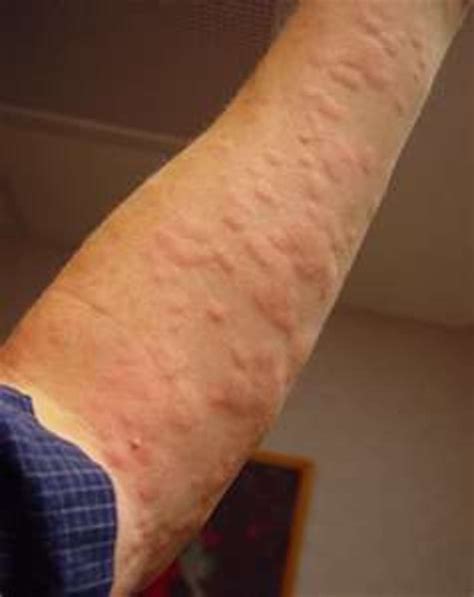 Hives Symptoms Can Stress Cause Rash And Treatment To Help Allergic