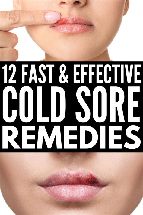 Fast And Effective 12 Natural Cold Sore Remedies That Work Natural