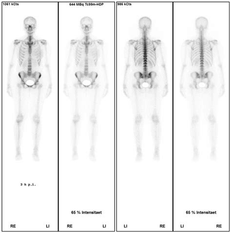 Die szintigraphie der schilddrüse wird ergänzend zur schilddrüsensonographie durchgeführt. Skelettszintigraphie | Kantonsspital St.Gallen