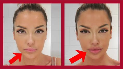 The Truth About My Lip Fillers Youtube