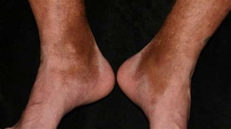 How To Get Rid Of Dark Skin Spots On Legs