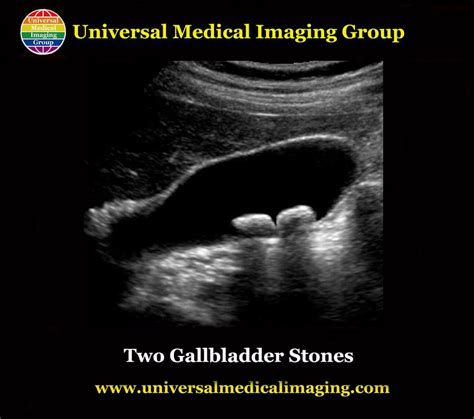 Ultrasound Of Gallbladder Stones Yelp