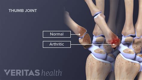 Does Cracking Your Knuckles Cause Arthritis