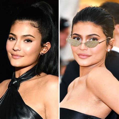 how kylie jenner could be dissolving her filler doctor commentary