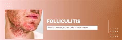 Folliculitis Types Causes Symptoms And Treatment Ushc