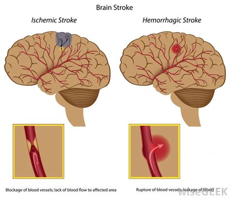 A hemorrhagic stroke can happen when blood from an artery begins bleeding into the brain after a blood vessel bursts. What is the Difference Between an Ischemic Stroke and a ...