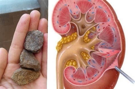 Gambar Ginjal - picture.idokeren