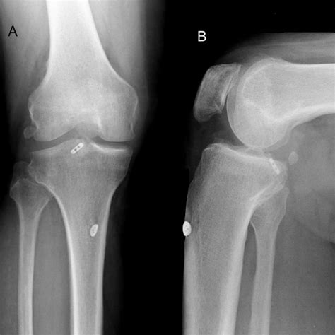 Anteroposterior A And Lateral B Radiographs Six Month After Surgery