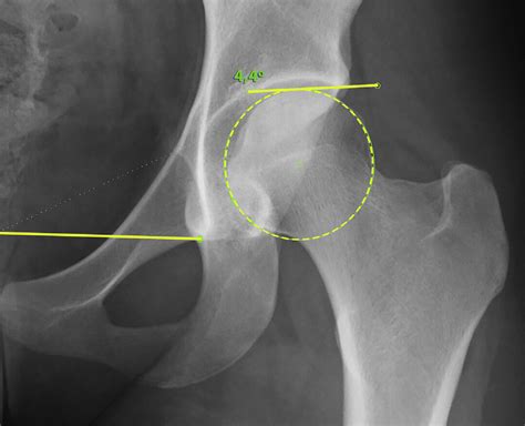 Anteroposterior Radiograph Of A Left Hip Showing A Tönnis Angle