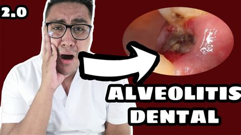Alveolitis Dental2 Que Hacer En El 2020 ¿infecciÓn DespuÉs De Una ExtracciÓn Youtube