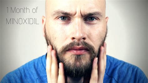 Minoxidil Beard Journey Month Update Youtube