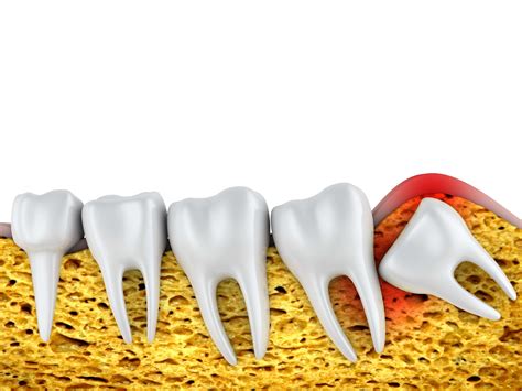 Serious Complications From Impacted Wisdom Teeth Top Cosmetic Dentist