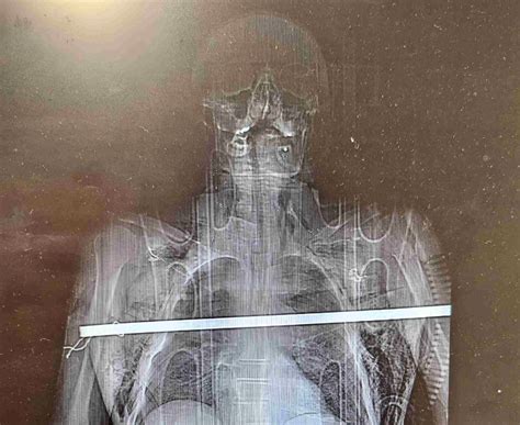 Man Miraculously Survives Being Impaled By Huge Iron Rod In Freak Cherry Picking Mishap Need