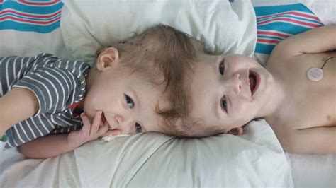 Separating Conjoined Twins Only The Beginning Of Challenges Philly