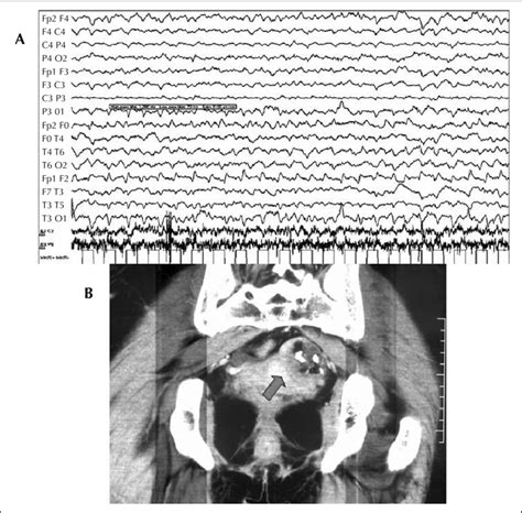 A Ictal Eeg Recording Showing Diffuse Slow Background With Periodic