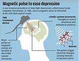 Pictures of Depression Treatment Electrical Stimulation