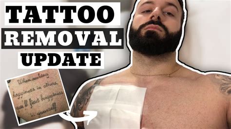 Finally Seeing Progress In Laser Tattoo Removal Youtube