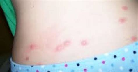 Bed Bugs Bites On Human Body Imgur