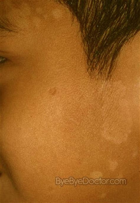 This is because these are the ages do u have it on your face? tinea versicolor on face - pictures, photos