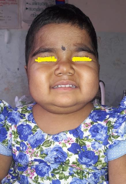 Purushothaman Kuzhikkathu Kandiyil Two Cases Of Precocious Puberty Case