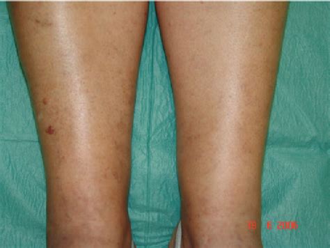 Figure 1 From Pigmentation Due To Stasis Dermatitis Treated