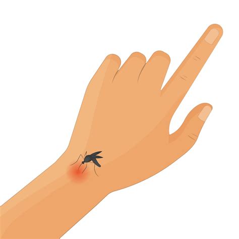5 Best Home Remedies For Mosquito Bites From The Odoc Blog