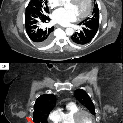 Pulmonary Angiogram Chest Ct Performed In The Emergency Department