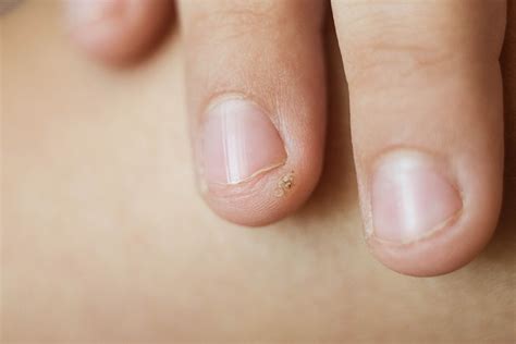 Top 3 Common Questions On Viral Warts Dr Hm Liew Skin Clinic