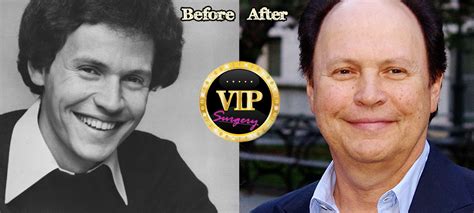 Billy Crystal Plastic Surgery Surgery Vip