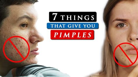 What Causes Pimples On Your Face And How To Get Rid Of It Youtube