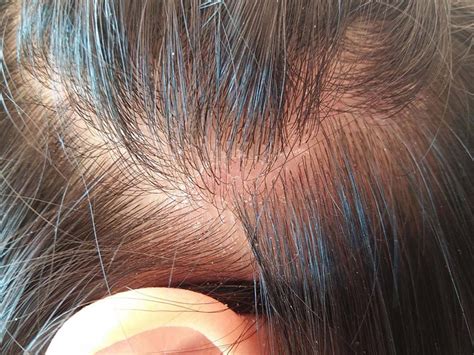 Dry Scalp Treatment The Failproof Guide For You Layla Hair Layla