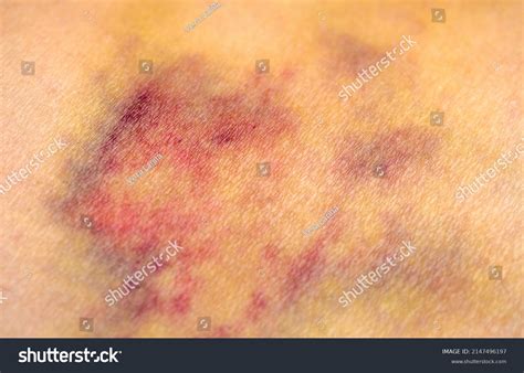 Bruises On Human Body Severe Bruise Stock Photo 2147496197 Shutterstock