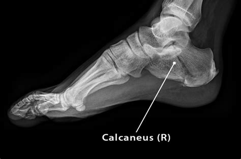 Calcaneus Heel Bone Definition Location Anatomy And Diagram