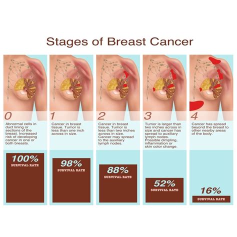 what do the stages of breast cancer mean best home design ideas