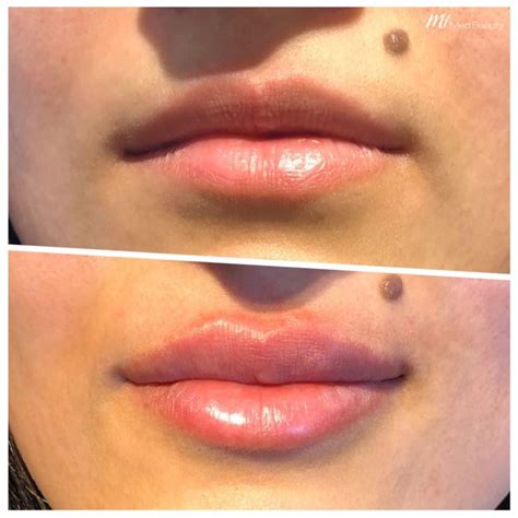 Before And After Treatment Pictures M1 Med Beauty Uk