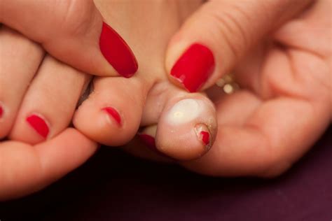 What To Do When You Get Blisters On Your Feet Pjuractive