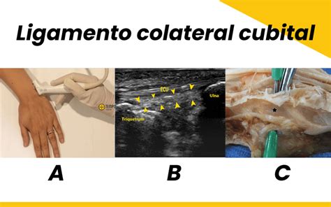 Ligamento colateral radial y ligamento colateral cubital Ecografía y
