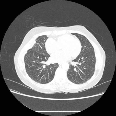 Pleural fluid studies were suggestive of a transudative process, though with some abnormal characteristics (including lymphocyte predominance, as well as presence of signet cells). Loculated pleural effusion | Radiology Case | Radiopaedia.org