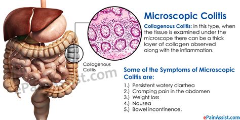 Microscopic Colitis Treatment Diet Symptoms Diagnosis Causes