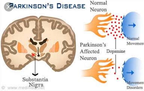 Parkinson S Disease Symptoms Causes Stages Treatment Santripty