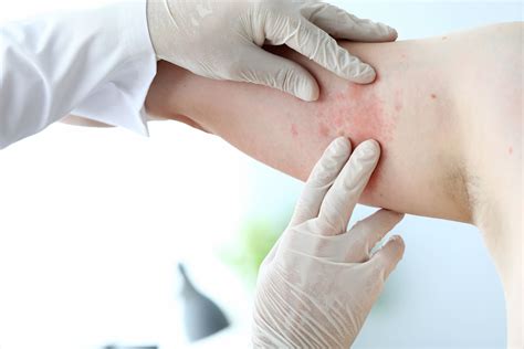 Skin Allergies Dermatologist Singapore Skin Specialist Clinic Rdsc