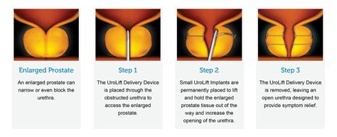 Urolift Relief From Bph Symptoms The Oregon Clinic