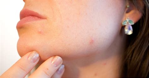 Pimples Vs Cold Sores Differences Causes And Treatment