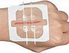 Buy Zip Stitch Sutures 2.8 x 2.36 inches, zipstitch Laceration Closures ...