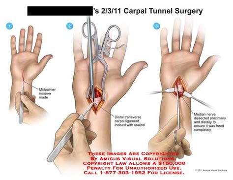 Amicus Illustration Of Amicus Surgery Wrist Carpal Tunnel Ligament Median Nerve
