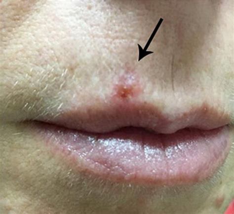 Basal Cell Carcinoma Lip