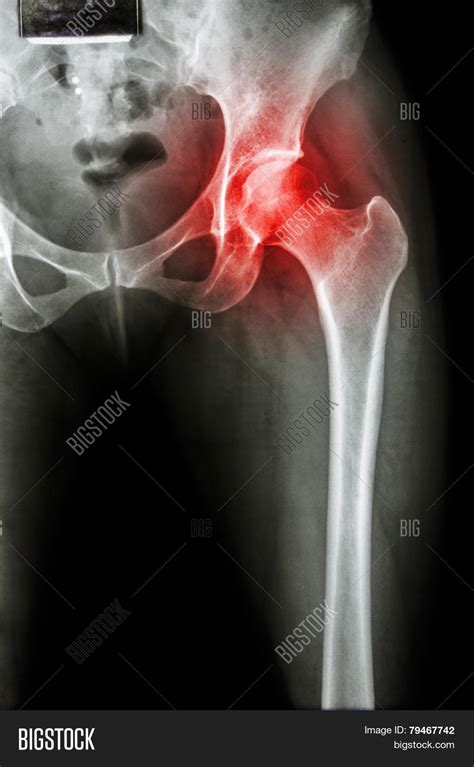 Arthritis Hip Joint X Ray Pelvis Image And Photo Bigstock