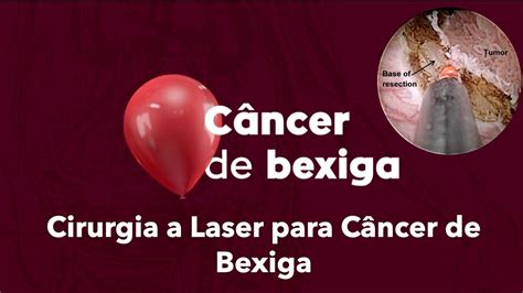 Cirurgia a Laser para tratamento do câncer de bexiga YouTube